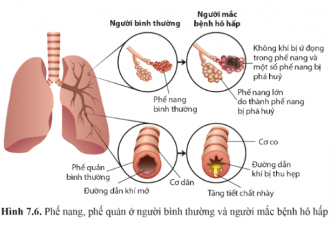 Quan sát hình 7.6 trang 48, nêu sự khác biệt ở phế nang và phế quản giữa người bình thường và người mắc bệnh hô hấp.