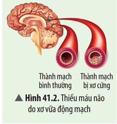 Nếu các thành mạch dẫn máu lưu thông lên não bị xơ cứng (Hình 41.2) thì hiện tượng gì sẽ xảy ra?