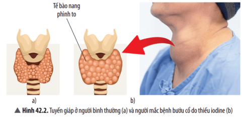 Quan sát Hình 42.2, cho biết tuyến giáp ở người bình thường và người mắc bệnh bướu cổ có gì khác nhau. Nguyên nhân dẫn đến sự khác nhau này là gì?