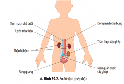 Bạn A cho rằng ghép thận là cắt quả thận bị hỏng và thay vào đúng vị trí đó một quả thận mới, khỏe mạnh. Đọc thông tin SGK, quan sát Hình 39.2 và cho biết ý kiến của bạn A đúng hay sai. Tại sao?