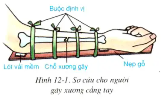 Giải sinh 8 bài 12: Thực hành Tập sơ cứu và băng bó cho người gãy xương