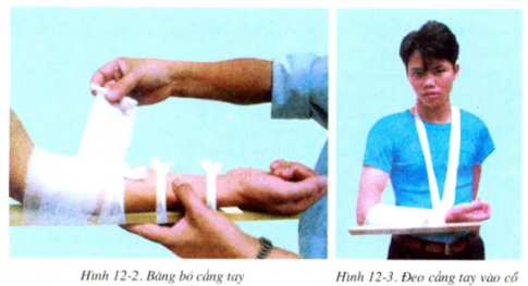 Giải sinh 8 bài 12: Thực hành Tập sơ cứu và băng bó cho người gãy xương