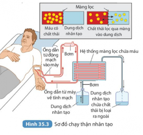  Dựa vào hình, em hãy mô tả lại quá trình lọc máu nhờ chạy thận nhân tạo.